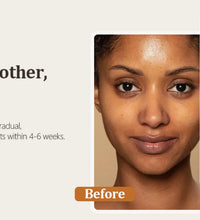 Turmeric Kojic Acid Glow Soap – Dark Spot & Acne Removal