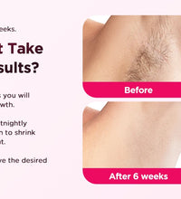 IPL Laser Hair Removal Device – 990,000 Flashes for Men & Women