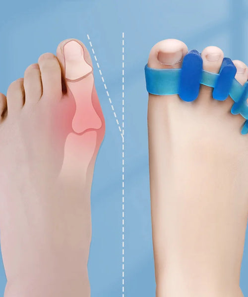 Toe Separator & Bunion Corrector – Hallux Valgus & Toe Spreader