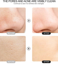 Ultrasonic Skin Scraper – Blackhead & Deep Pore Cleaner